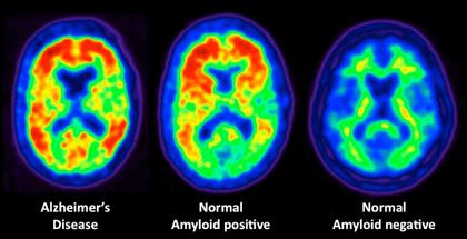 a new PET scan offers hope of more effective early diagnosis of Alzheimer’s disease.